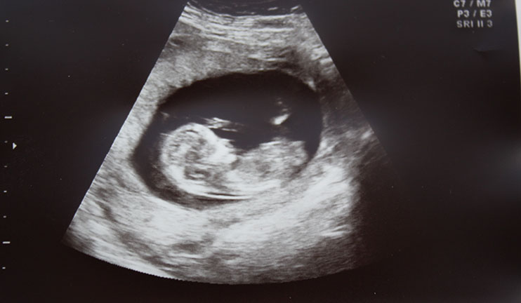 Սելեկտիվ աբորտների պատճառով  տարեկան չի ծնվում 1500-2000 հայ աղջիկ