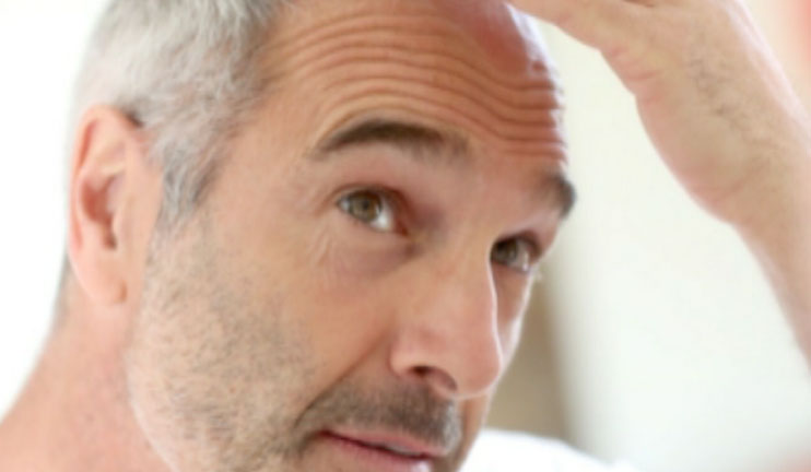 What are the factors that contribute to premature graying of hair