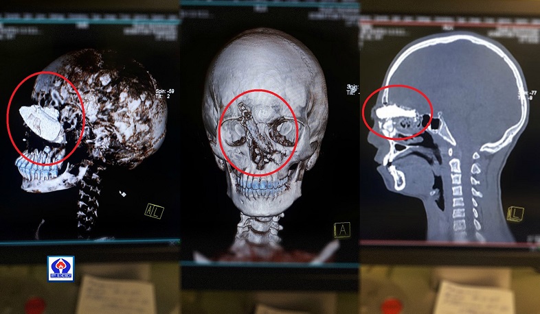 15-ամյա տղան ծանր վիրավորվել է անկյունային հղկիչի հետ աշխատելիս