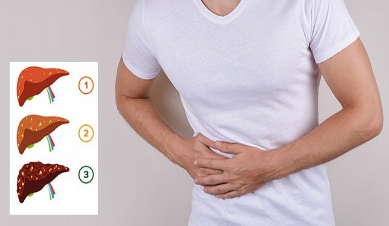 Լյարդի ոչ ալկոհոլային ճարպակալումը՝ 21-րդ դարի էպիդեմիա