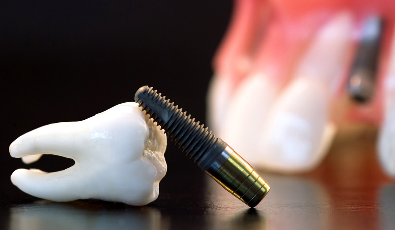 «Եթե ցավում է...» Իմպլանտ