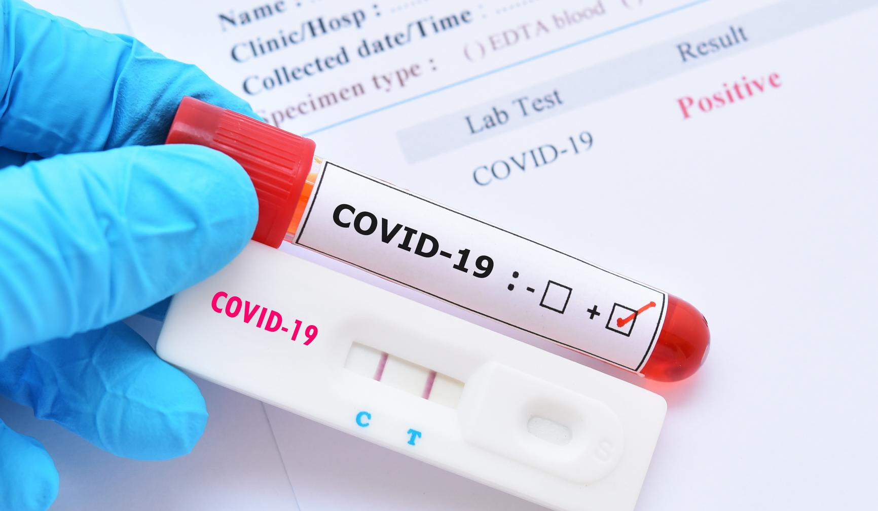 В Грузии выявлено 24 616 новых случаев заболевания коронавирусом