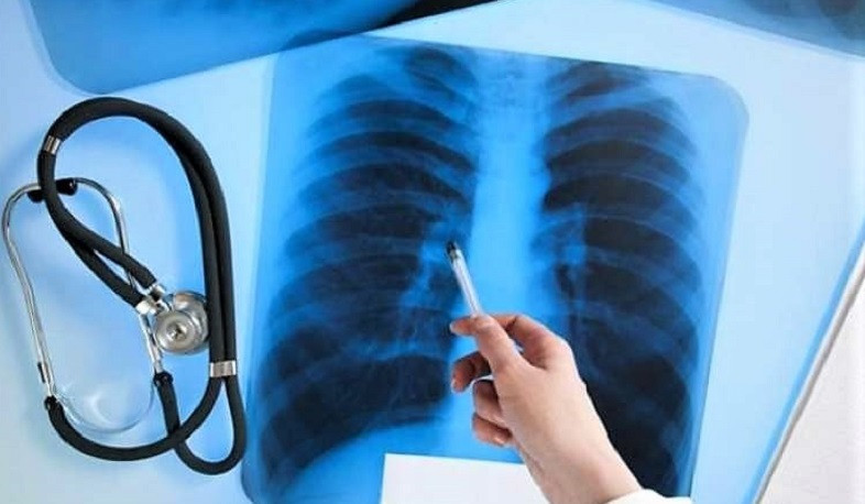 Վերջին տարիներին տուբերկուլոզի բուժման արդյունավետությունը Արցախում 90 տոկոսից բարձր է