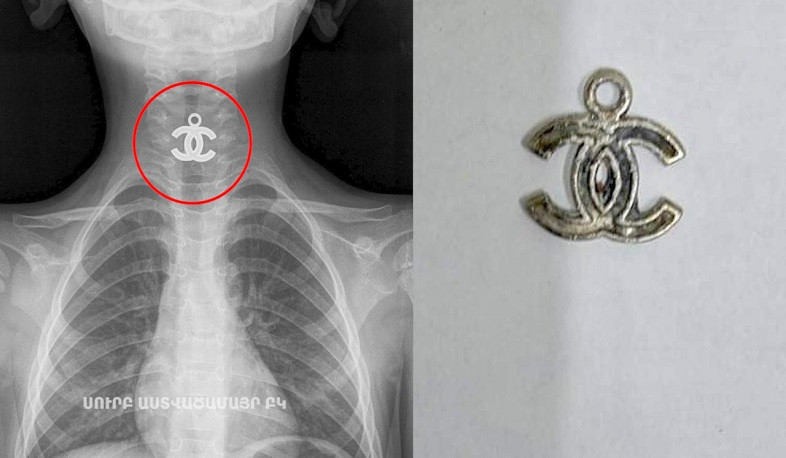 Բժիշկները 4-ամյա երեխայի կերակրափողից մետաղյա կախազարդ են հեռացրել