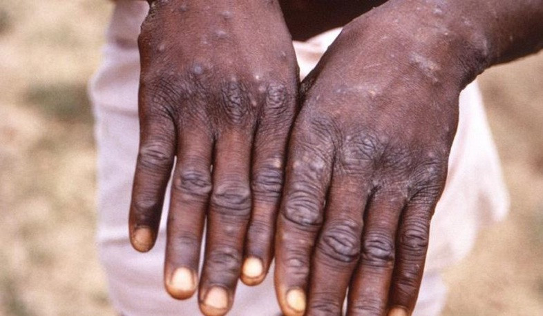 Ինչ ախտանշաններ են բնորոշ Կապիկի ծաղիկ հիվանդությանը և ինչպես կանխարգելել այն