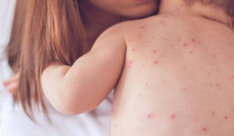 Առողջապահության նախարարությունը մտադիր է ջրծաղիկի դեմ պատվաստանյութ ձեռք բերել