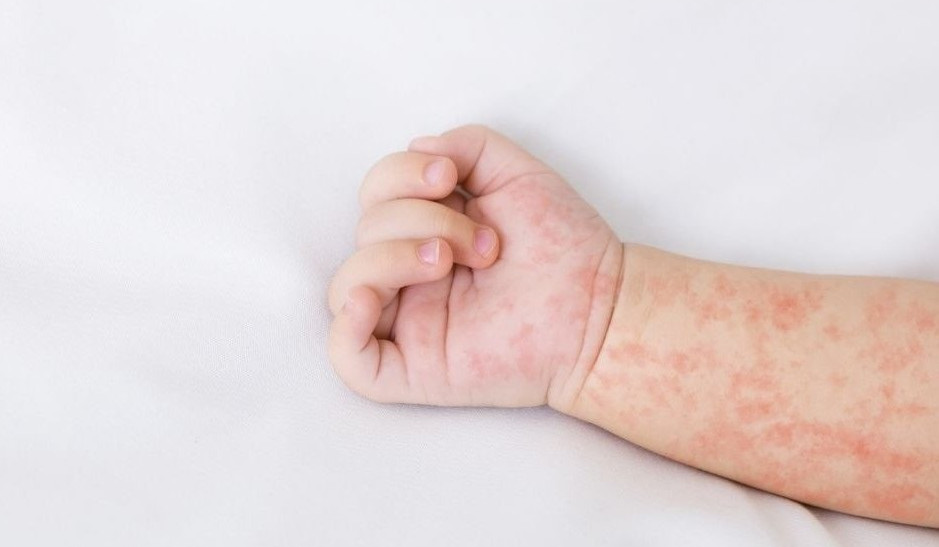 Կարմրուկի լաբորատոր հաստատված դեպքերի թիվը հասել է 200-ի. ՀՎԿԱԿ