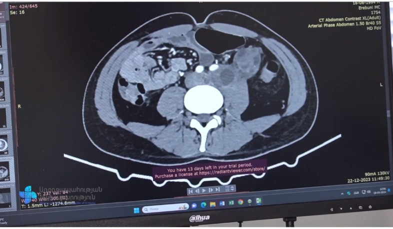 Բարդագույն վիրահատության շնորհիվ 29-ամյա երիտասարդի կյանքը փրկվել է