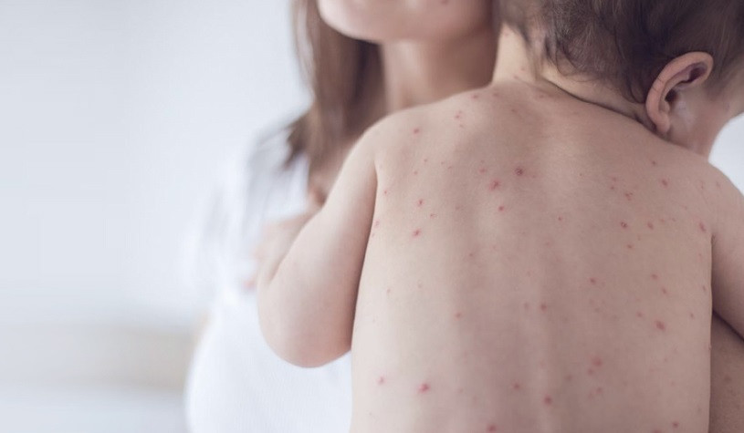 Նախորդ շաբաթվա համեմատ` կարմրուկի լաբորատոր հաստատված դեպքերն աճել են 27-ով