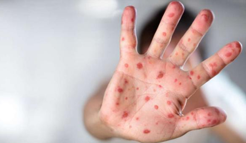 No local cases of measles registered