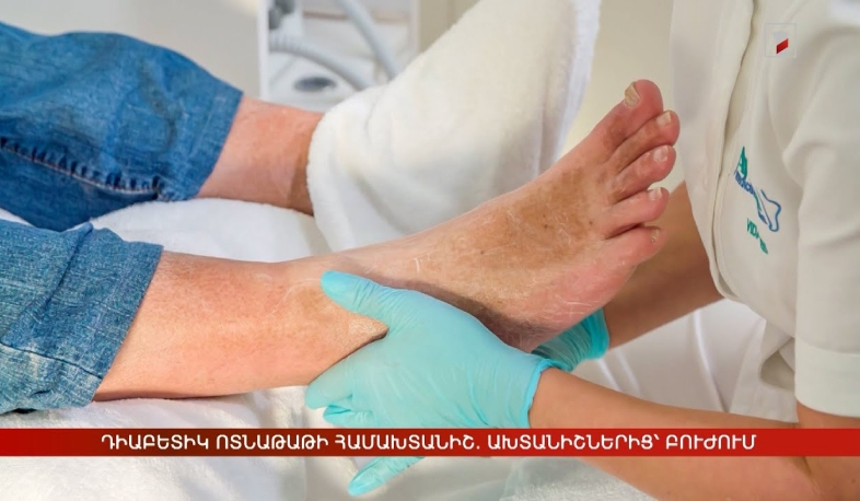 Դիաբետիկ ոտնաթաթի համախտանիշ. ախտանիշներից՝ բուժում