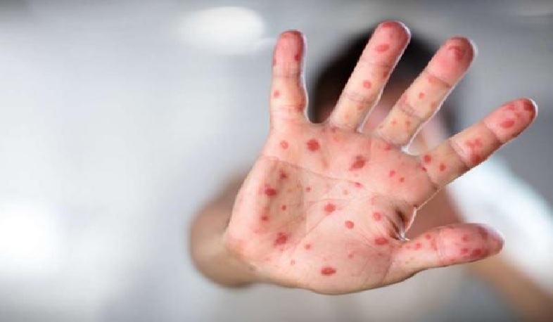 Measles case confirmed by laboratory