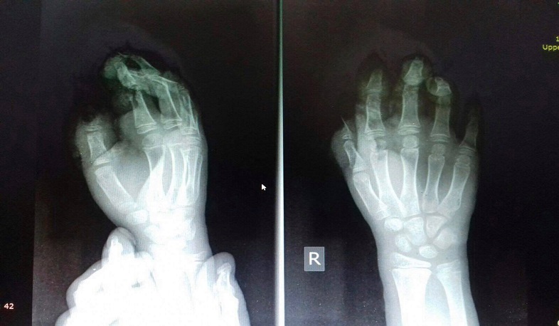 Արսեն Թորոսյանը՝ ամանորյա պայթուցիկների վտանգների մասին