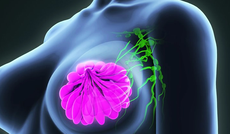 Մեկնարկել է «Տրաստուզումաբ» դեղով կրծքագեղձի քաղցկեղի բուժման ծրագիրը